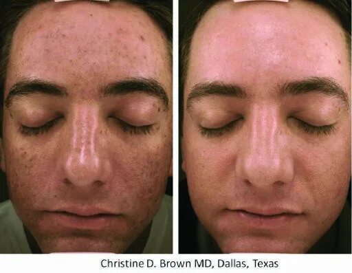 Prp для лица до и после фото Micro Needling Phoenix, Arizona Luminosa Medical Spa