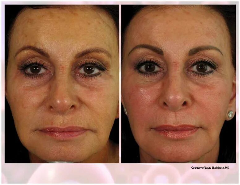 Prp для лица до и после фото PRP Facial Near Me PRP Facial Treatment PRP Facial Benefits