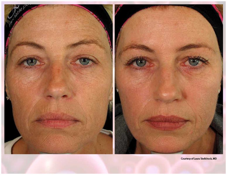 Prp для лица до и после фото PRP Facial Near Me PRP Facial Treatment PRP Facial Benefits
