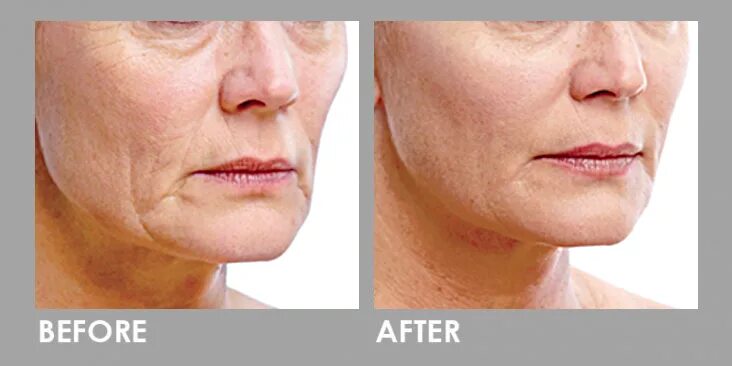 Prp для лица до и после фото Platelet Rich Plasma (PRP) Injection for Large Pores Treatment