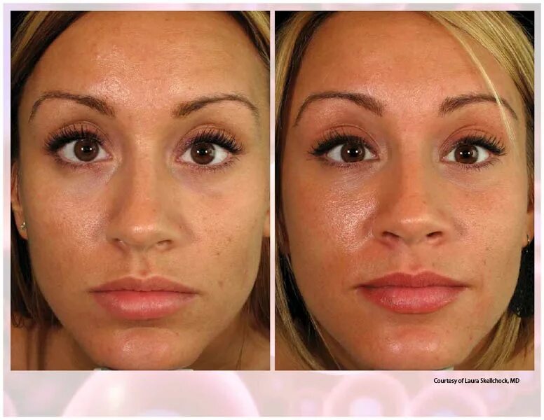 Prp для лица до и после фото Prp For Skin Whitening on Sale xn--h1aahyg1df.xn--p1ai
