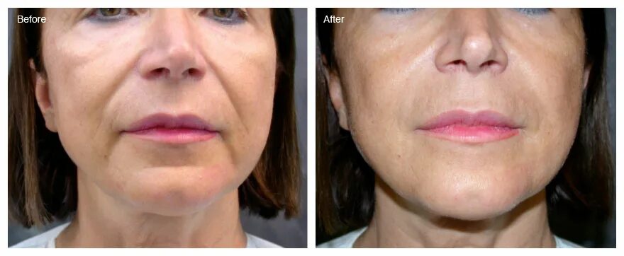 Prp для лица до и после фото PLATELET RICH PLASMA (PRP) Treatment - Bedford Skin Clinic