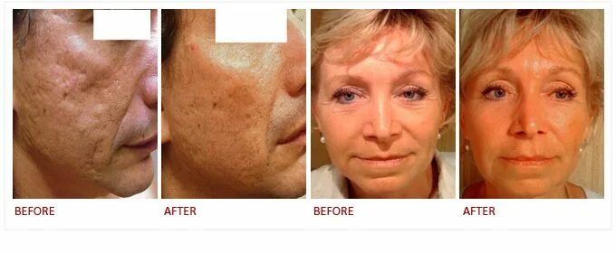 Prp для лица до и после фото Health Coaching Health Beauty Confidence United States