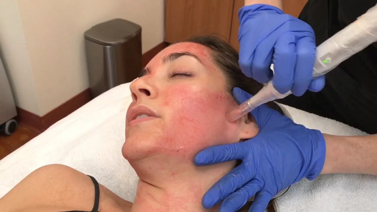 Prp терапия лица до и после фото Microneedling with PRP Demo Beleza MedSpa Austin, TX - YouTube
