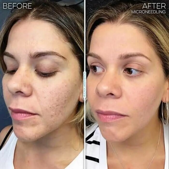 Prp терапия лица до и после фото Spa Services Instructions Before, After, Next Steps - Juvly Aesthetics
