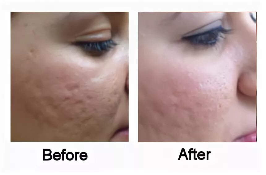 Prp терапия лица до и после фото The Benefits of PRP Injections and Why You Should Get Them - RushPR News