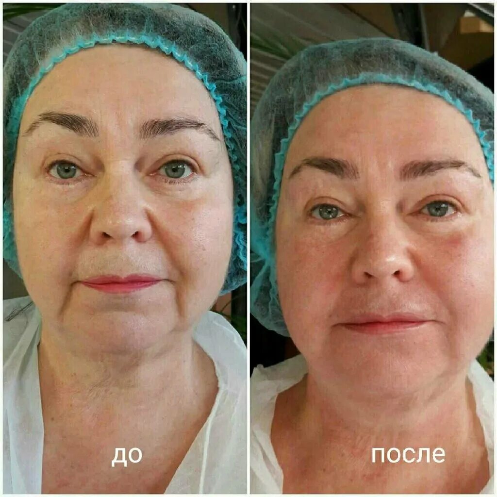 Prp терапия лица до и после фото Panorama: Nice, beauty salon, Russia, Ivanovo, ulitsa Kukonkovykh, 128 - Yandex 