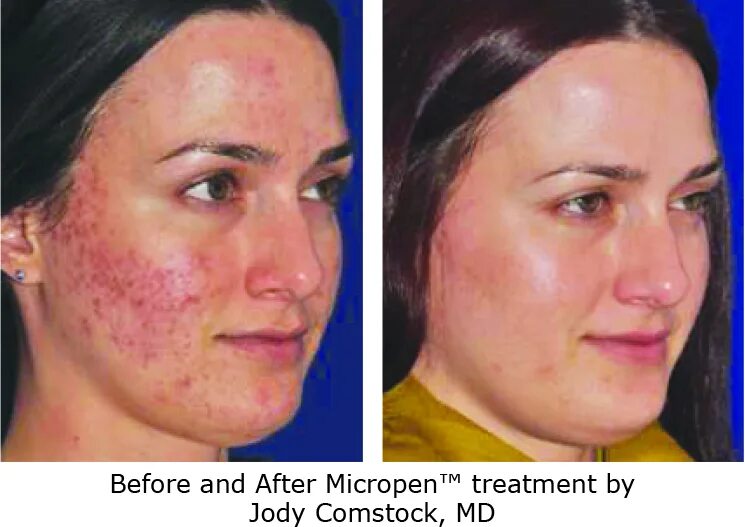 Prp терапия лица до и после фото Microneedling (Micro-Pen) Face Treatment - Buy Online