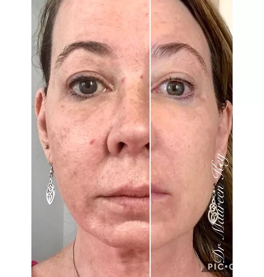 Prp терапия лица до и после фото Platelet-Rich Plasma in Pueblo, Colorado - Vampire Facials