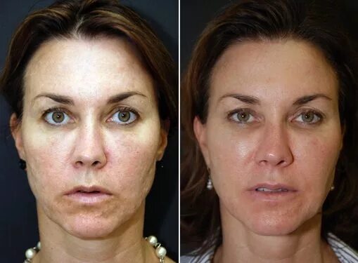 Prp терапия лица до и после фото Vampire Facial PRP Facial Face R-X Medspa