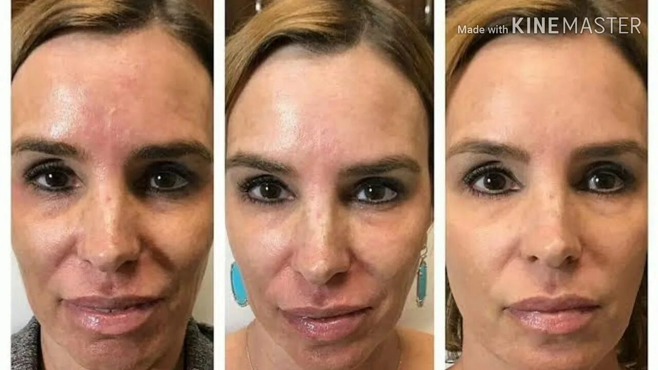 Prp терапия лица до и после фото PRP FOR FACE COST IN INDIA - YouTube