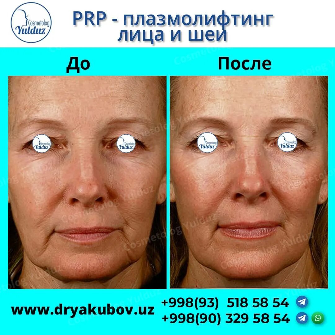 Prp терапия лица до и после фото Плазмолифтинг лица, суть процедуры, отзывы, результаты и фото