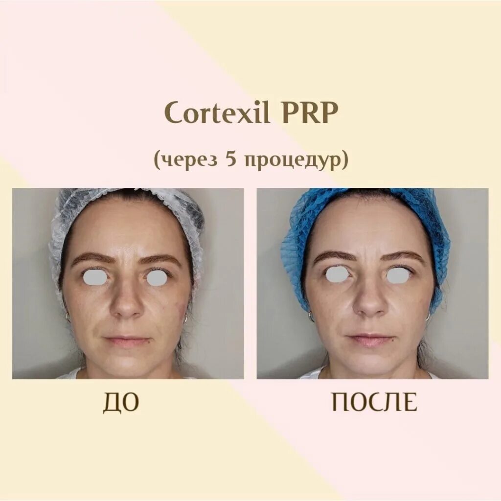 Prp терапия лица до и после фото Скачать фотографию PRP ТЕРАПИЯ CORTEXIL № 34