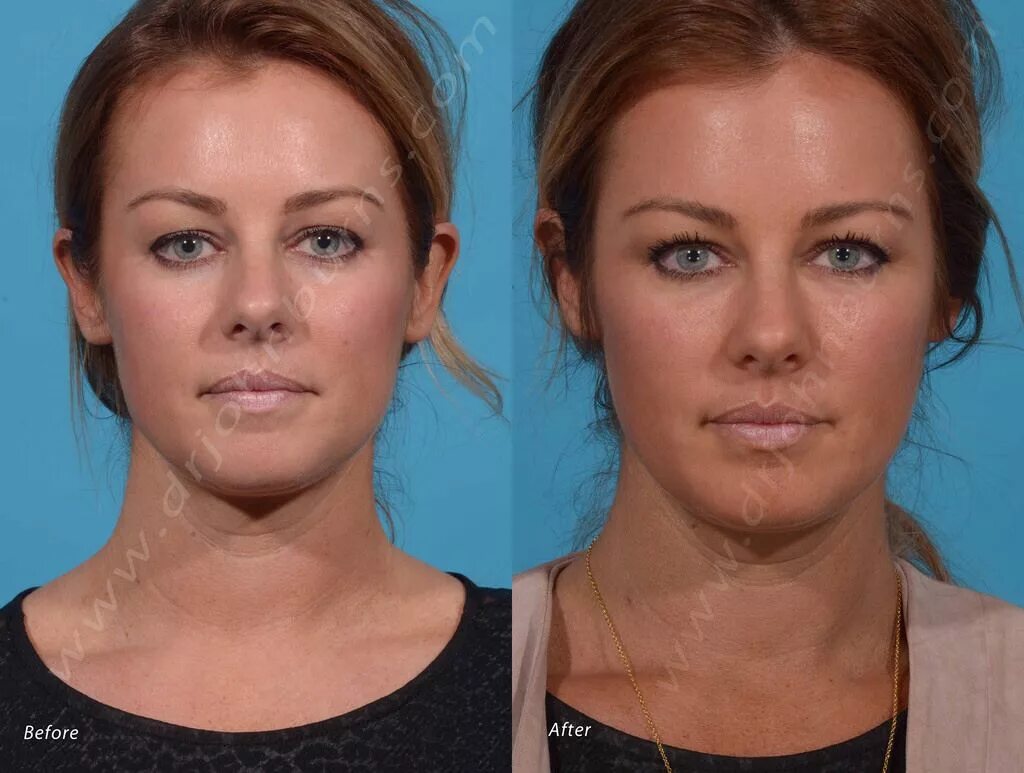 Radiesse для лица фото до и после Radiesse Facial Filler Facial fillers, Med spa, Nasolabial folds