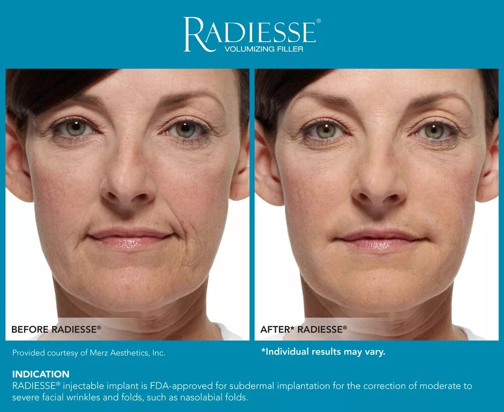 Radiesse для лица фото до и после EM01034-00_RADIESSE_E-mediaKit_BA_FullFace_Female-3 - Serenity MedSpa