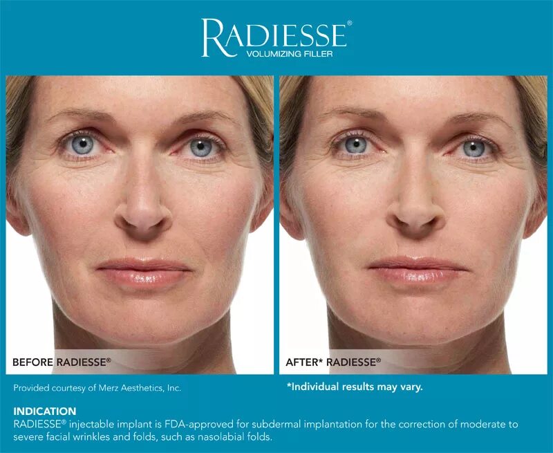 Radiesse для лица фото до и после Radiesse in New Jersey SOMA Skin & Laser