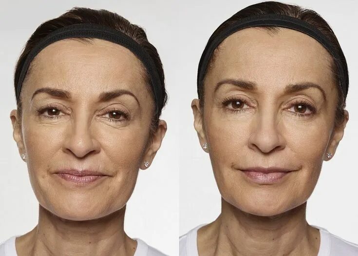 Radiesse для лица фото до и после goji - موثوق - Mawto9 in 2021 Beauty full girl, Beauty full, Beauty