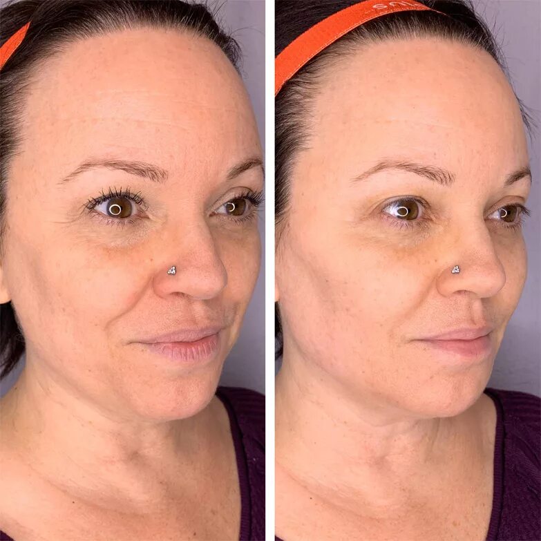 Radiesse для лица фото до и после Radiesse for Hands and Face Boston Dr. Holly Happe