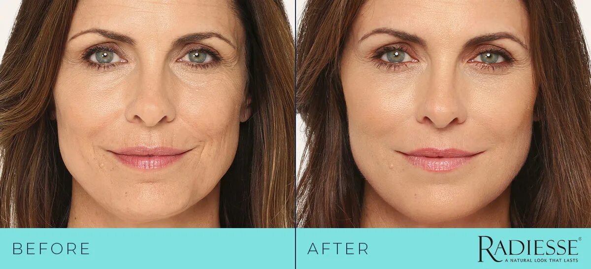 Radiesse для лица фото до и после Radiesse Knoxville Dermal Fillers in Knoxville TN Dr. Doppelt
