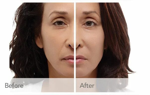 Radiesse фото до и после Damris' Results with Radiesse! Dermal fillers, Treatment, Smile lines