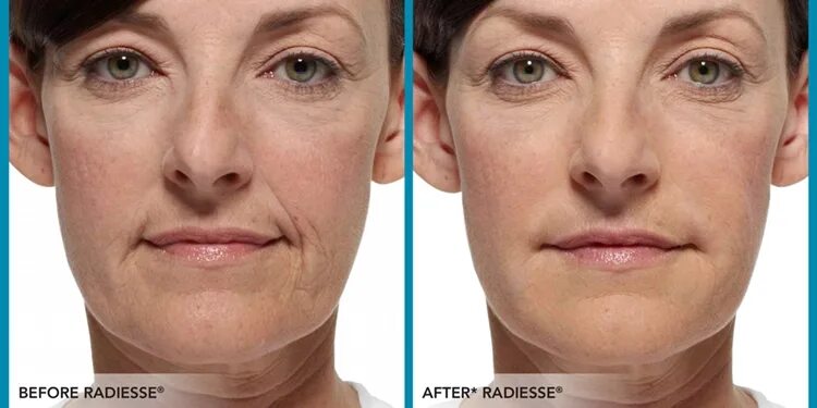Radiesse фото до и после Векторный лифтинг Радиес