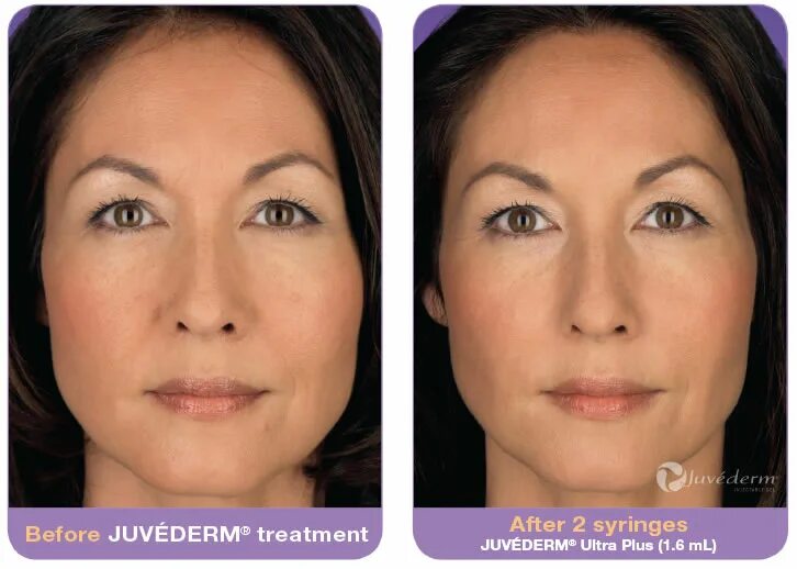 Radiesse фото до и после Juvéderm ® Fillers in Rock Hill, SC Metrolina Medical Associates