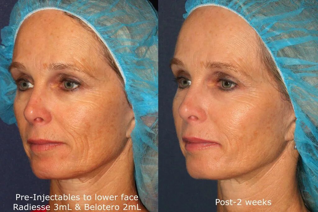 Radiesse фото до и после Fine Lines and Wrinkles Treatment San Diego, CA CLDerm