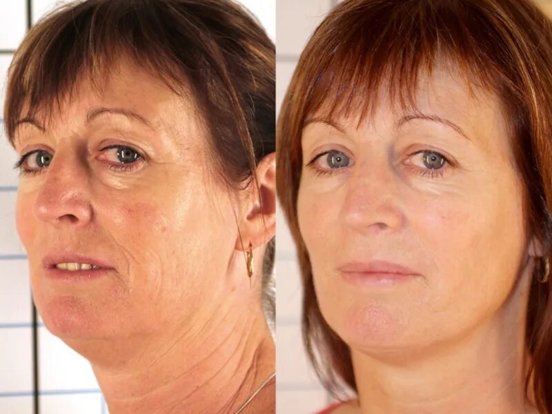 Rf лифтинг лица до и после фото Photochromotherapy + RF - Lux Medicus