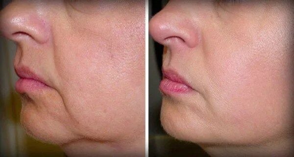 Rf лифтинг лица до и после фото No More Wrinkles and Sagging Skin on Your Face - 2 Ingredients only! Gesicht mas