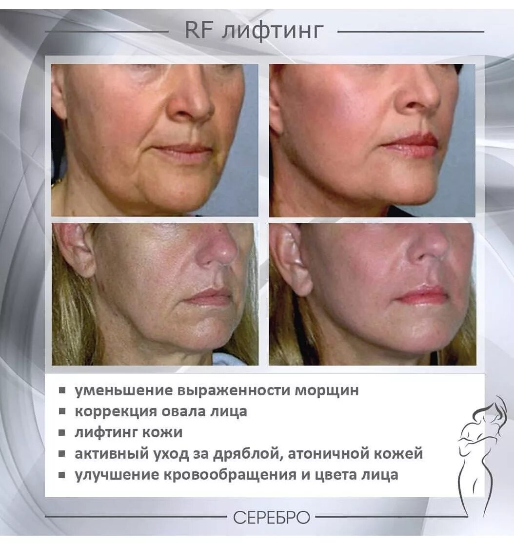 Rf лифтинг лица цена отзывы фото Аппаратное омоложение в Одессе: 143 мастера, 121 салон Отзывы, Цена, Фото - На д