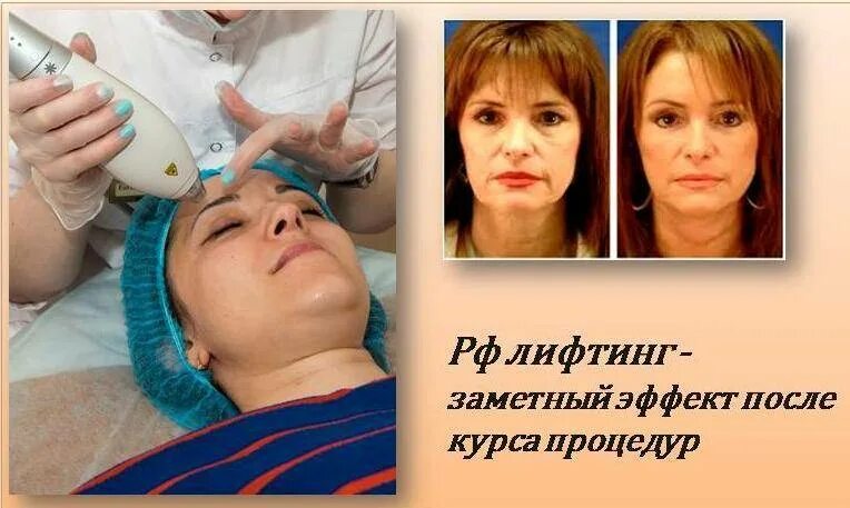 Rf лифтинг лица цена отзывы фото Термолифтинг лица и тела- плюсы и минусы, фото до и после процедуры