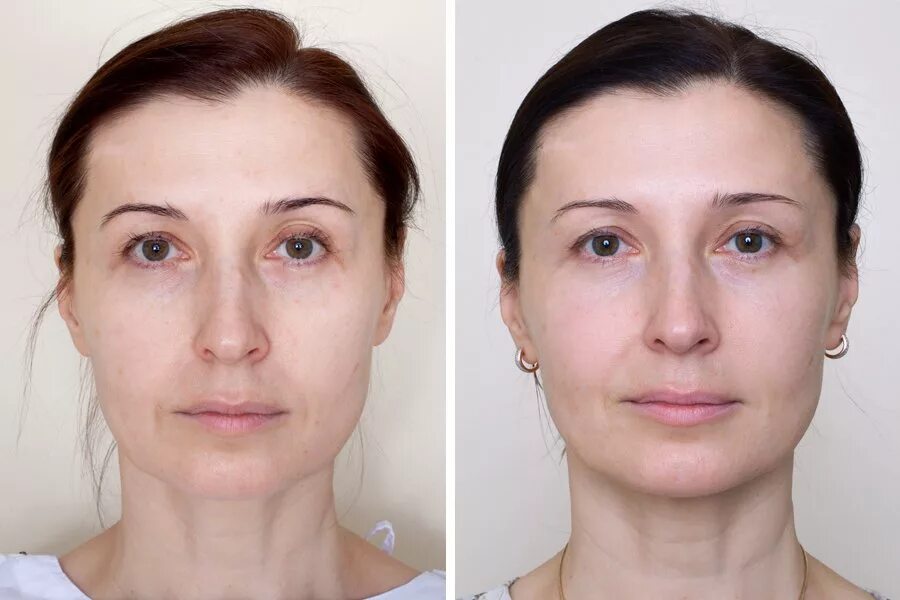 Rf лица фото до и после Эндотиновый лифтинг лица: отзывы Beauty Insider