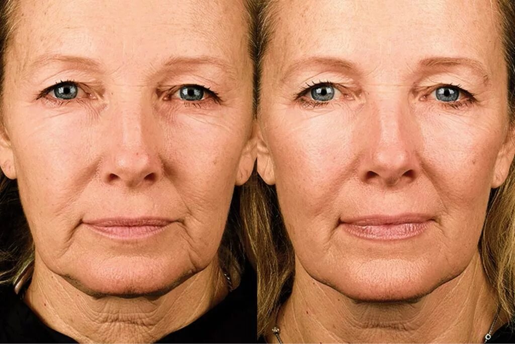 Rf лица фото до и после RF Face Lifting - Lux Medicus