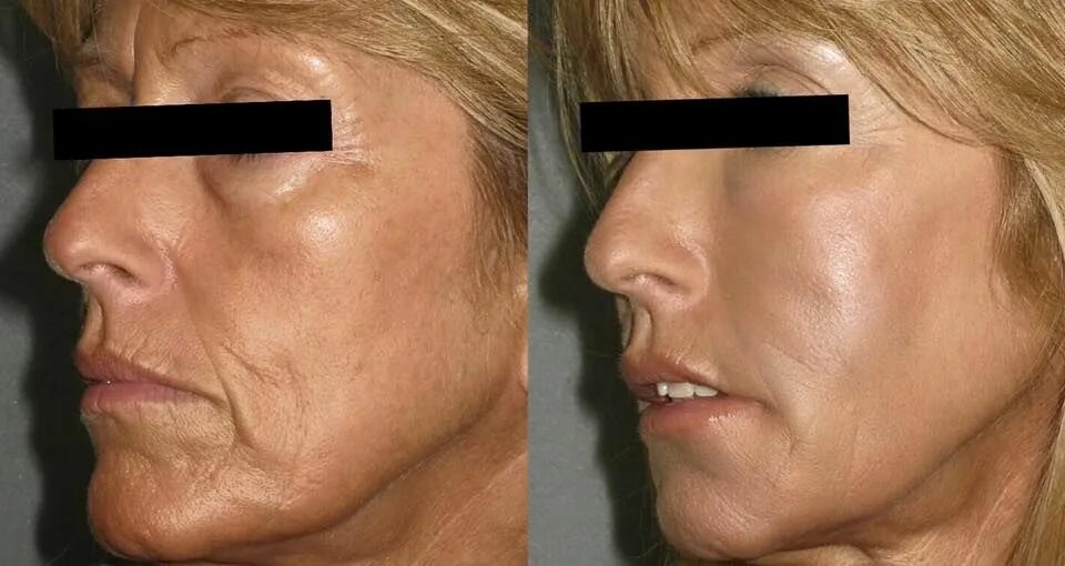 Rf лица фото до и после LIQUID FACE LIFT : Made By micro cannula And Ialuronic acid. All over face. Lift
