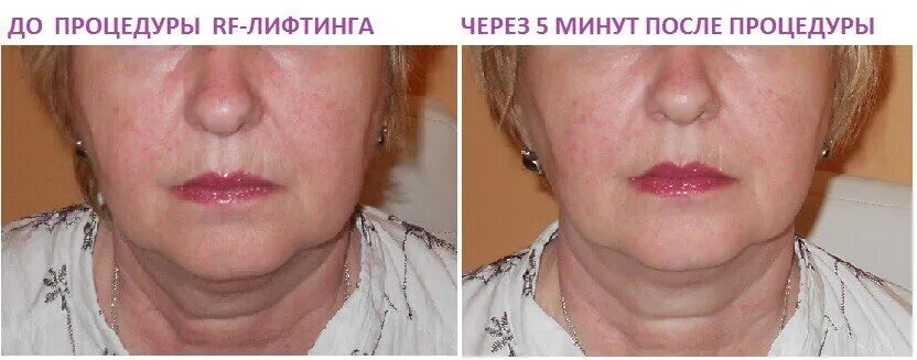 Rf лица фото до и после Ивановская барахолка IvBB.RU * Вакуумный массаж лица + RF лифтинг + инфракрасный
