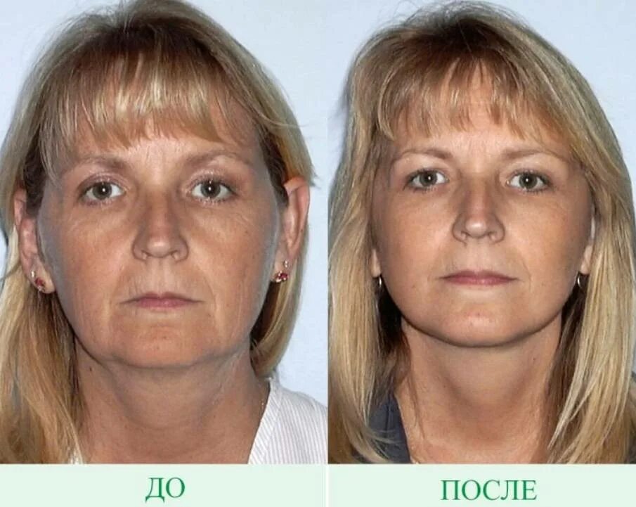 S лифтинг лица фото до и после Подтянуть лицо пластика
