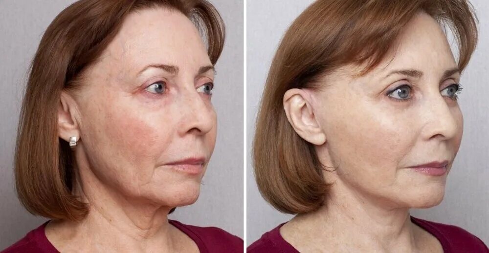 S лифтинг лица фото до и после Kosmetichesky kabinet Sakura, cosmetology, Brest, Maskoŭskaja vulica, 267к12 - Y
