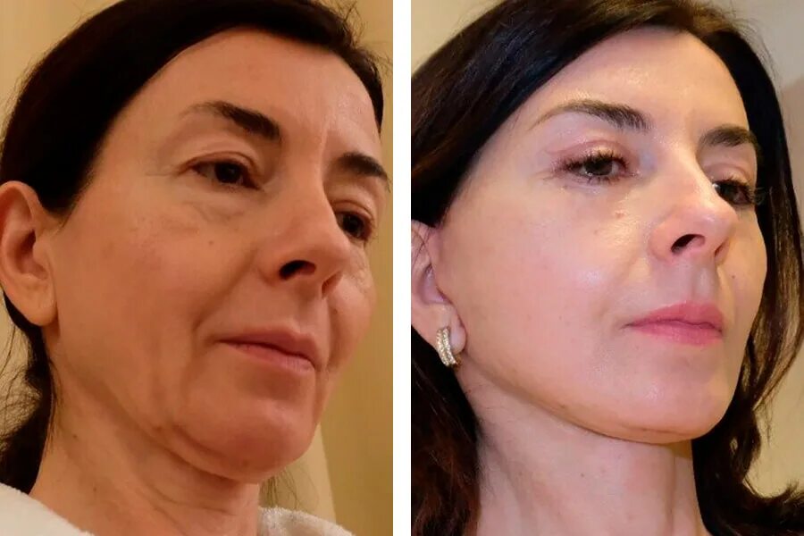 S лифтинг лица фото до и после Подтяжка подбородка