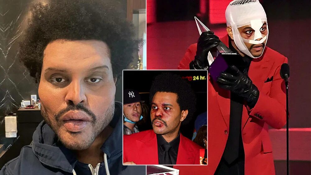 The weeknd фото до и после пластики What Happened To The Weeknd’s Face? His Bandages, Botox & Plastic Surgery Photos