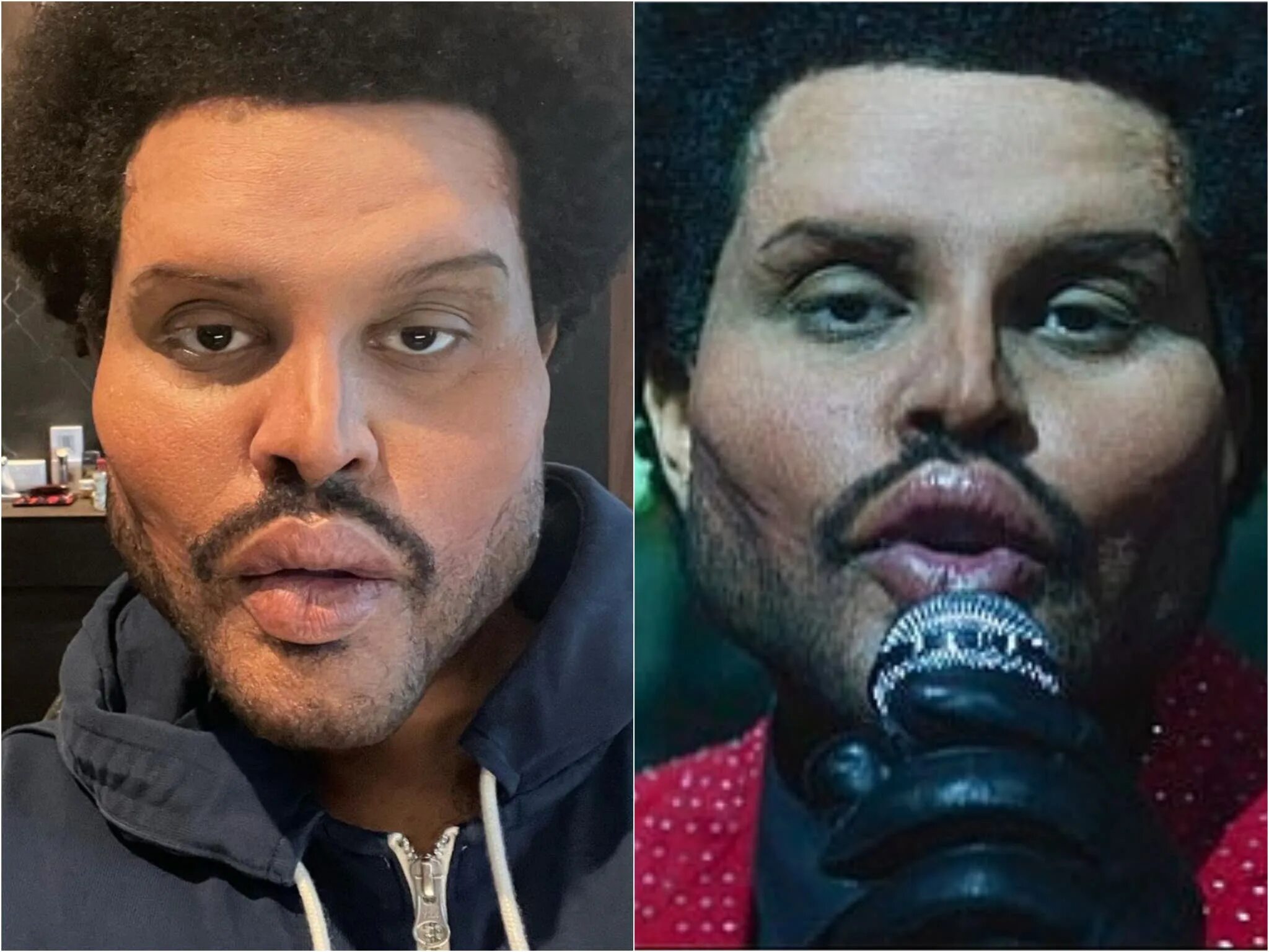 The weeknd фото до и после пластики What happened to The Weeknd’s face? Singer removes bandages to reveal 'creepy' p