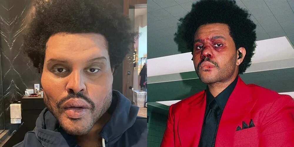 The weeknd фото до и после пластики Full Story Behind The Weeknd's Face Bandages at Super Bowl LV