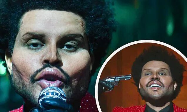 The weeknd фото после пластики The Weeknd has extreme Botox look in Save Your Tears music video