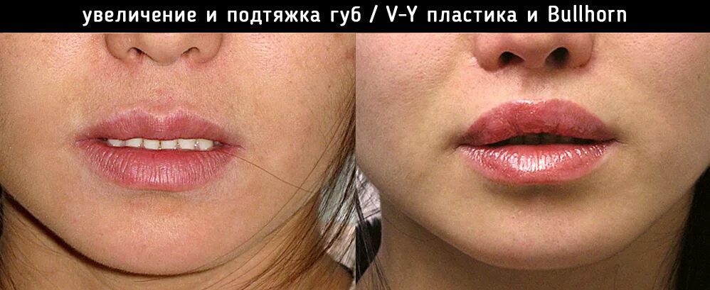 Vy пластика губ фото Хейлопластика (пластика губ) - как сделать красивые губы 3d пластика (новое в хи