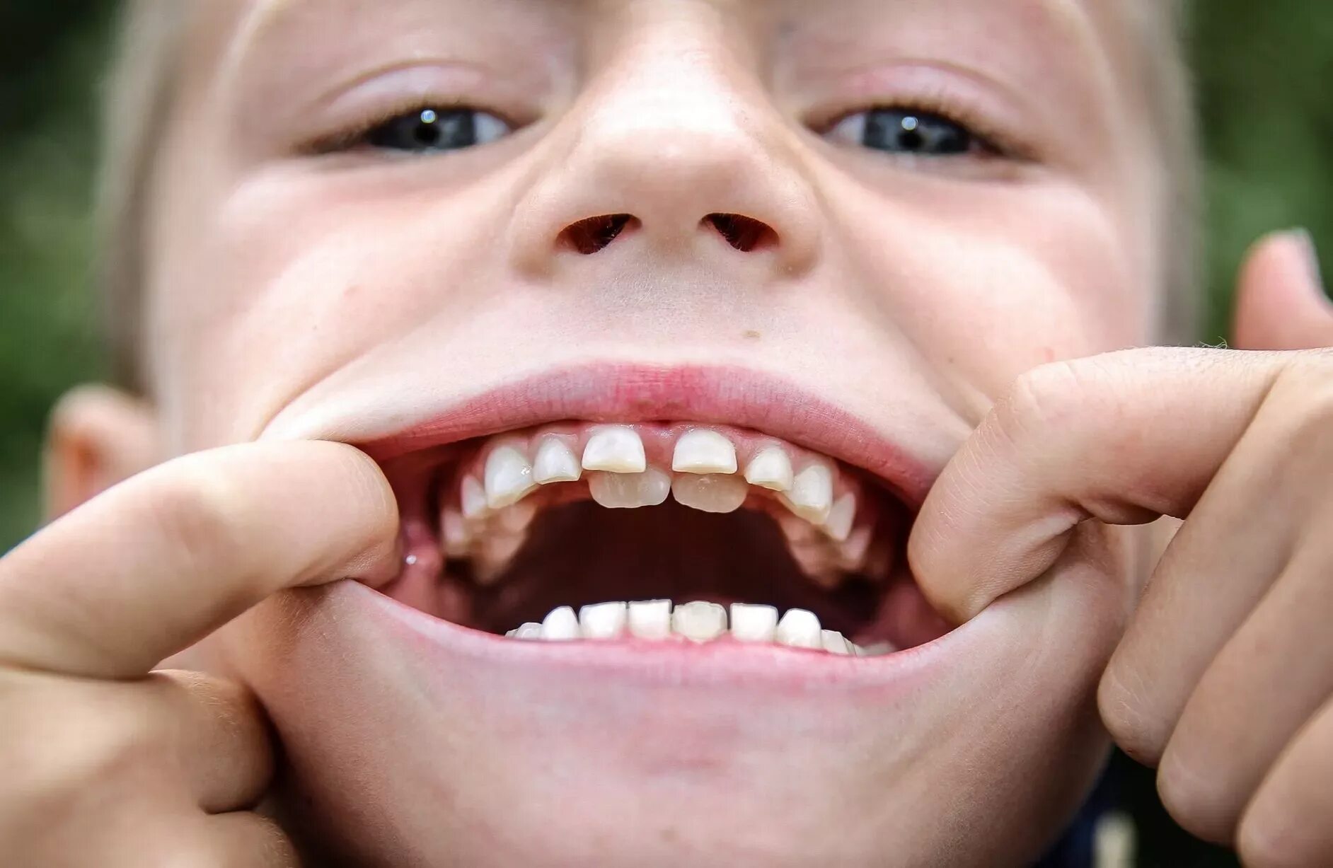 Акульи зубы у человека фото Schoolboy grows two sets of teeth - Mirror Online