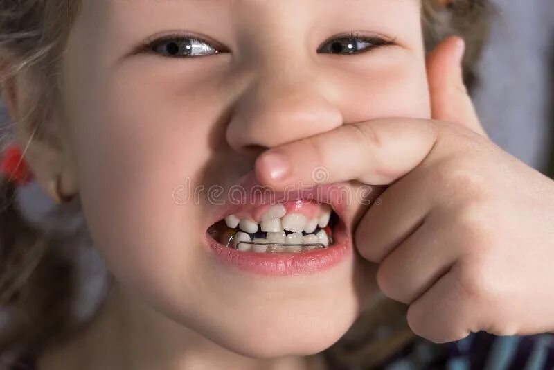 Акульи зубы у человека фото Adult Permanent Teeth Coming in Front of the Child`s Baby Teeth: Shark Teeth Sto