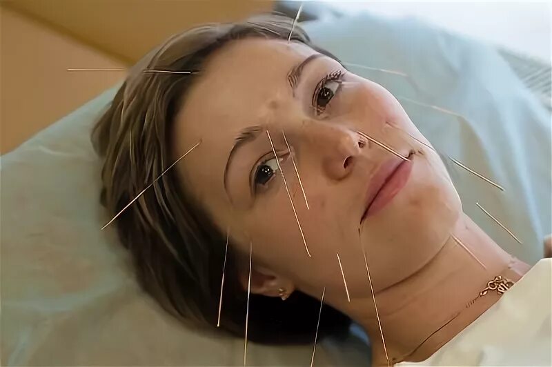 Акупунктура для лица фото до и после Cекреты иглоукалывания
