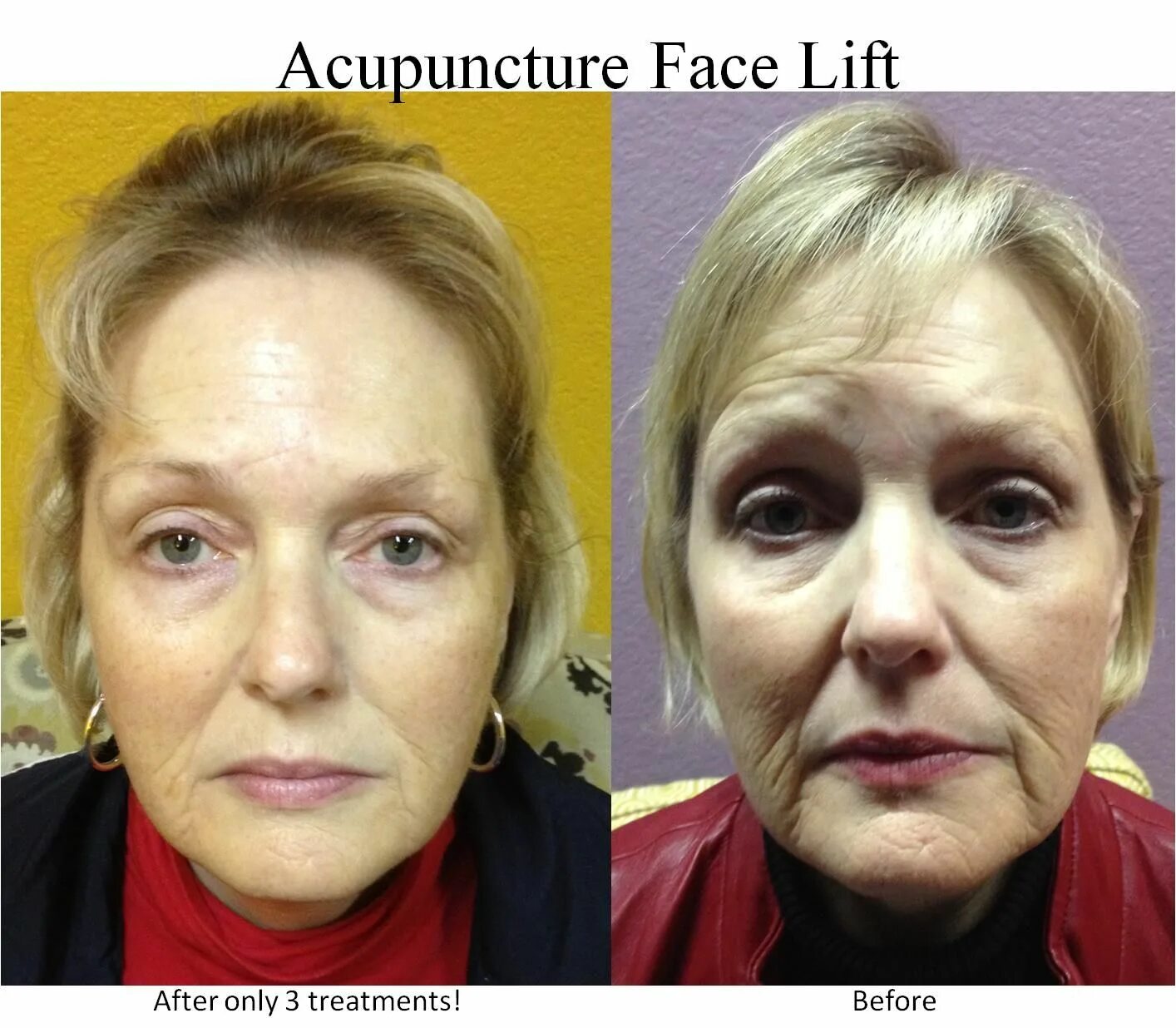 Акупунктура для лица фото до и после One of your patients! Acupuncture, Face, Facelift