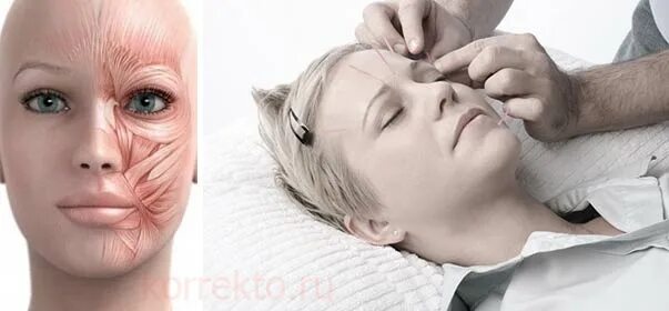 Акупунктура для лица фото до и после Суть процедуры иглоукалывания для омоложения лица