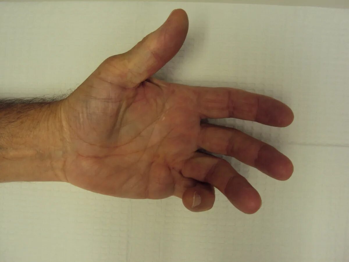 Акупунктурные точки при контрактуре дюпюитрена фото Dupuytren's: Dupuytren Distal Interphalangeal Joint Needle Fasciotomy
