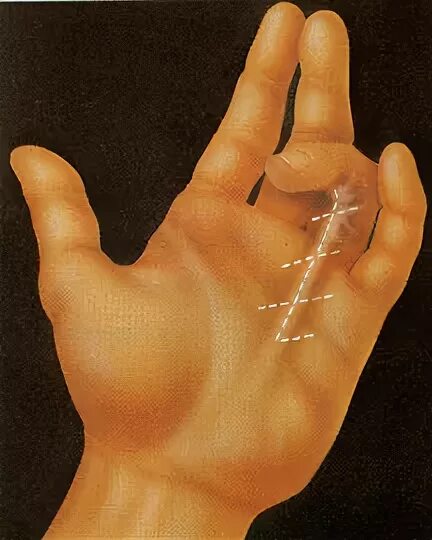 Акупунктурные точки при контрактуре дюпюитрена фото DOLORES VARIOS EN LA MANO - Blog de Fisioterapia